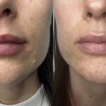 "استكشف تقنية الفراكشنال ليزر، الحل الأمثل لمشاكل البشرة مثل التجاعيد وندبات حب الشباب. تعرف على فوائدها، آثارها الجانبية، ونصائح العناية بالبشرة بعد العلاج للحصول على نتائج مذهلة."