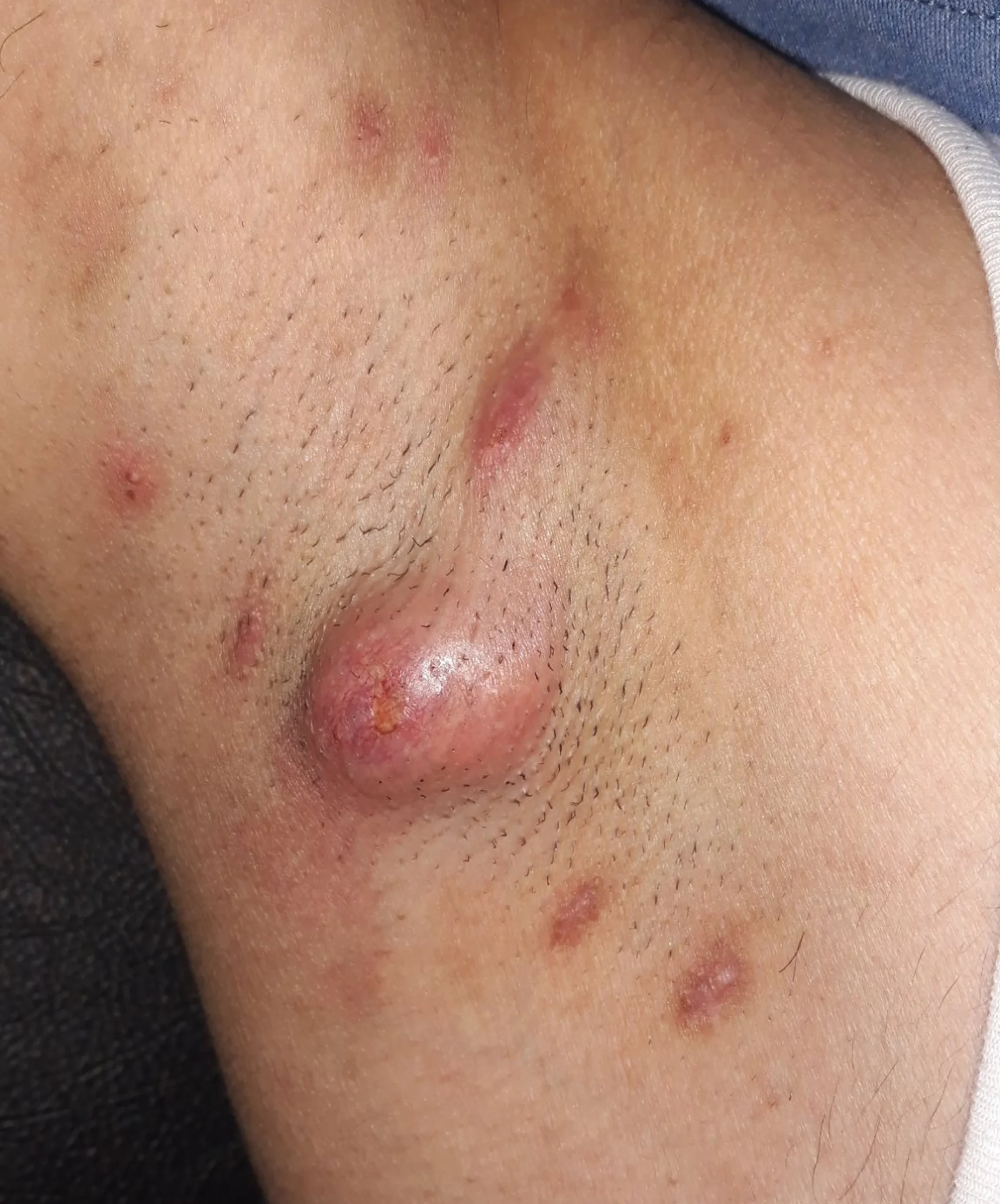 التهاب الغدد العرقية